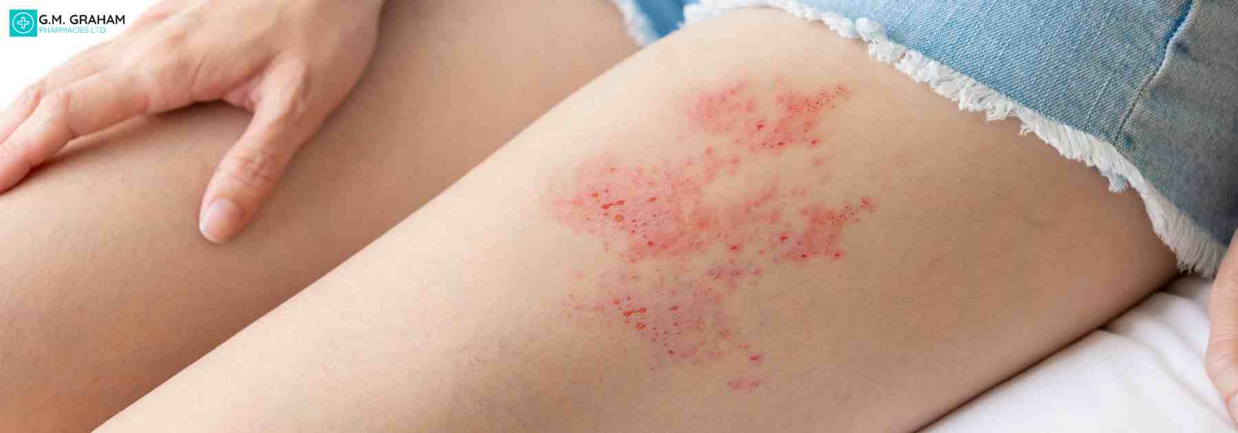 nhs shingles treatment