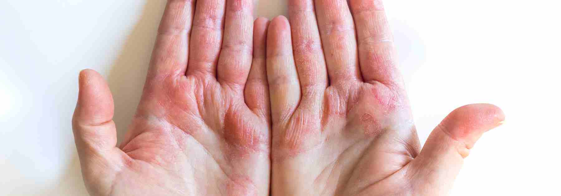 Eczema creams come with different ingreedients and we can help you explore them. 